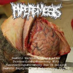 Hyperemesis : Hyperemesis - Hypoprothrombinemia